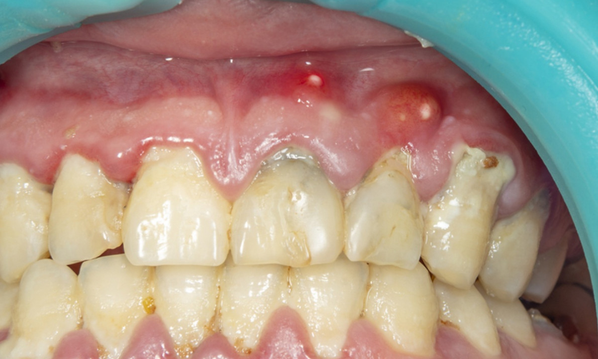 Απόστημα στο δόντι: 4 φυσικοί τρόποι αντιμετώπισης (εικόνες)