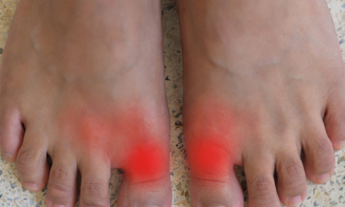 Ουρική αρθρίτιδα: Ποιοι κινδυνεύουν από τη φλεγμονώδη νόσο των αρθρώσεων (εικόνες)