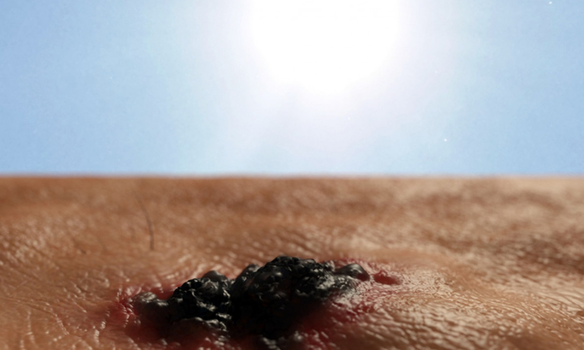 Καρκίνος δέρματος: Τα προειδοποιητικά σημάδια μέσα από φωτογραφίες