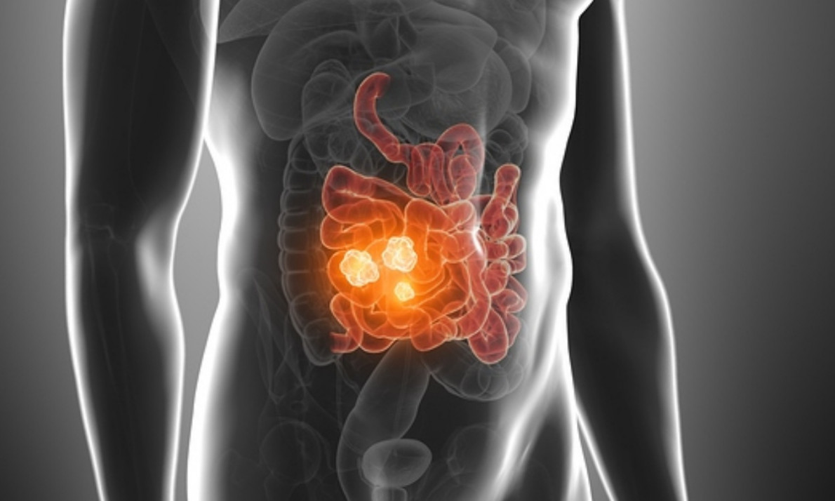 Ορθοκολικός καρκίνος: Οι παράγοντες που αυξάνουν τον κίνδυνο (εικόνες)