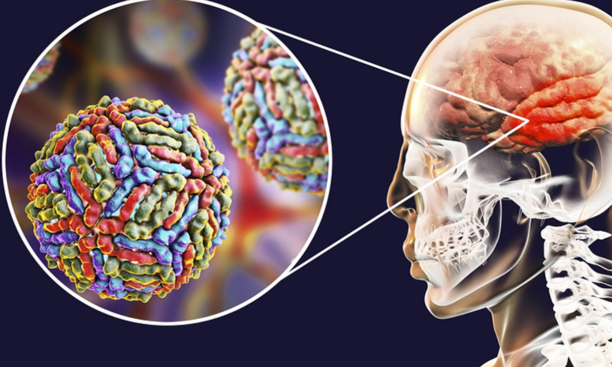 Εγκεφαλίτιδα: 6 ενδείξεις σε εικόνες