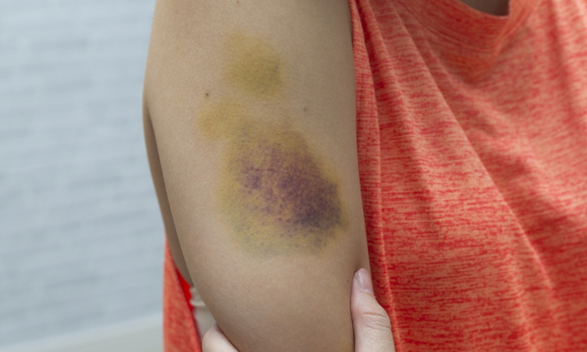 Μελανιάζετε εύκολα; Δείτε τις πιθανές αιτίες (εικόνες)