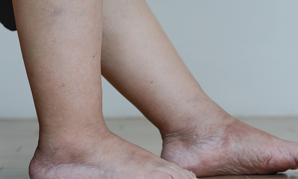 Πρησμένα πόδια: Τι να κάνετε για να υποχωρήσει το οίδημα (εικόνες)