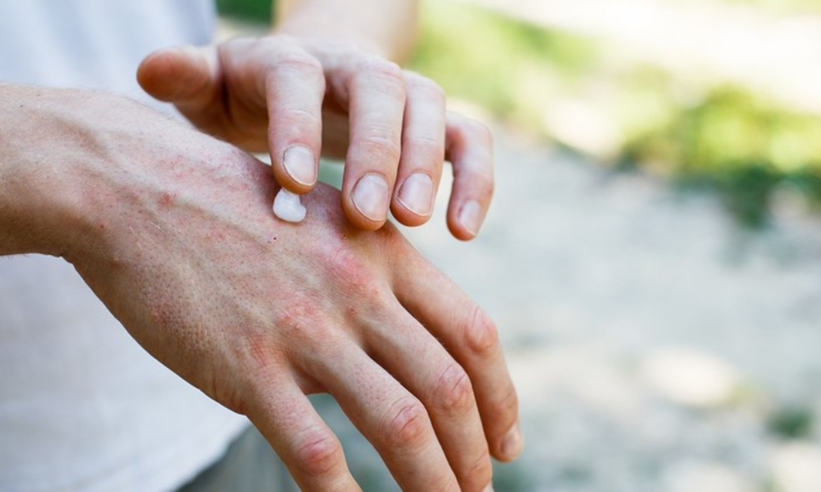 Ξηρή επιδερμίδα το καλοκαίρι: Πώς θα την αντιμετωπίσετε (εικόνες)