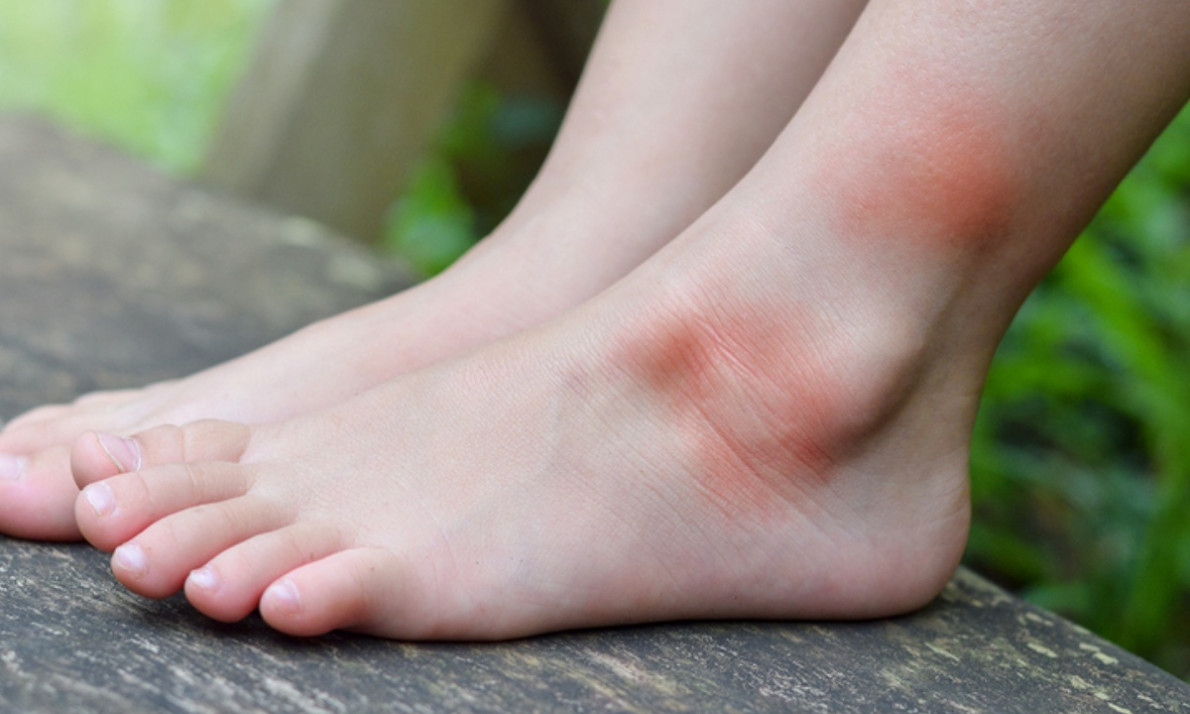 Αλλεργία στο τσίμπημα κουνουπιού: Τα ανησυχητικά συμπτώματα (εικόνες)