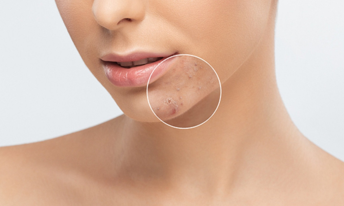 Ακμή και καλοκαίρι: Τι πρέπει να γνωρίζετε (εικόνες)