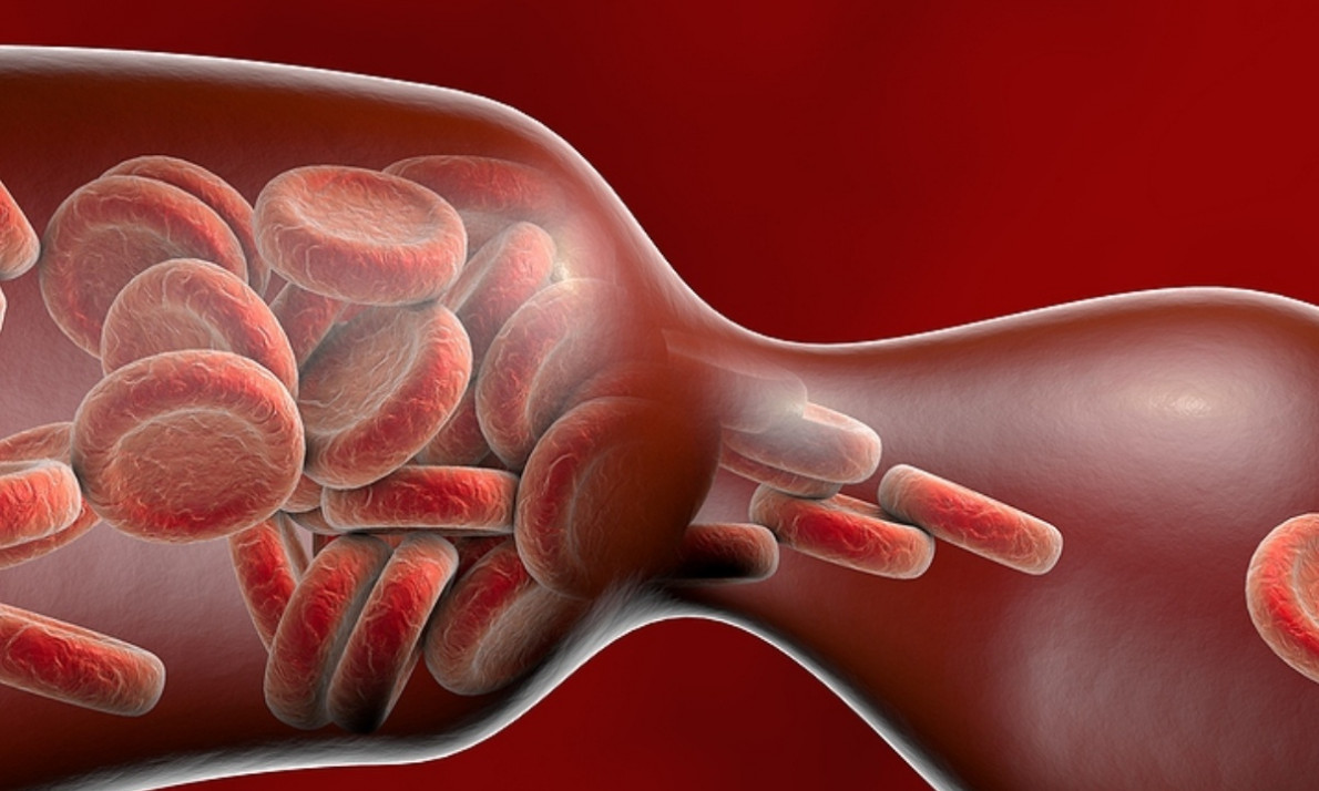 Θρόμβωση: Για ποιες αιτίες καρδιαγγειακού θανάτου ευθύνεται (εικόνες)