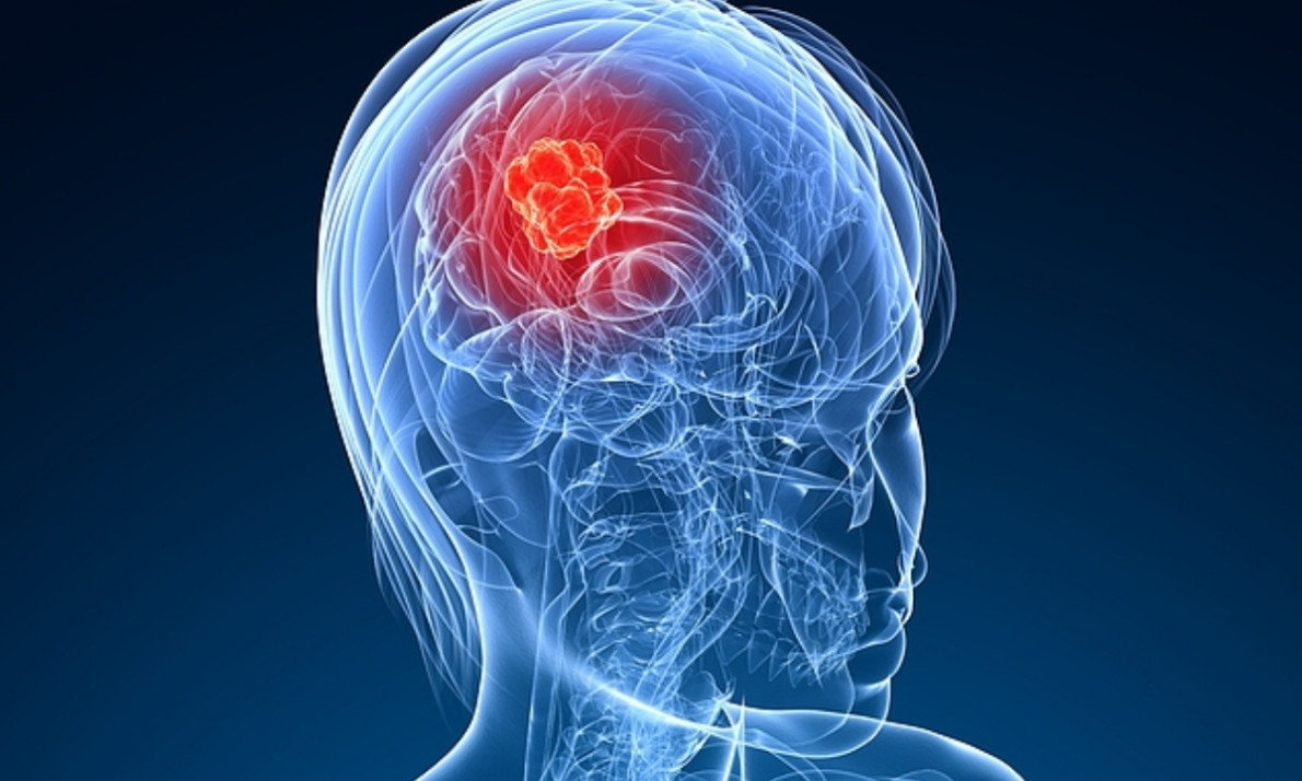 Καρκίνος στο κεφάλι: Κοινά συμπτώματα που δεν πρέπει να αγνοείτε (εικόνες)