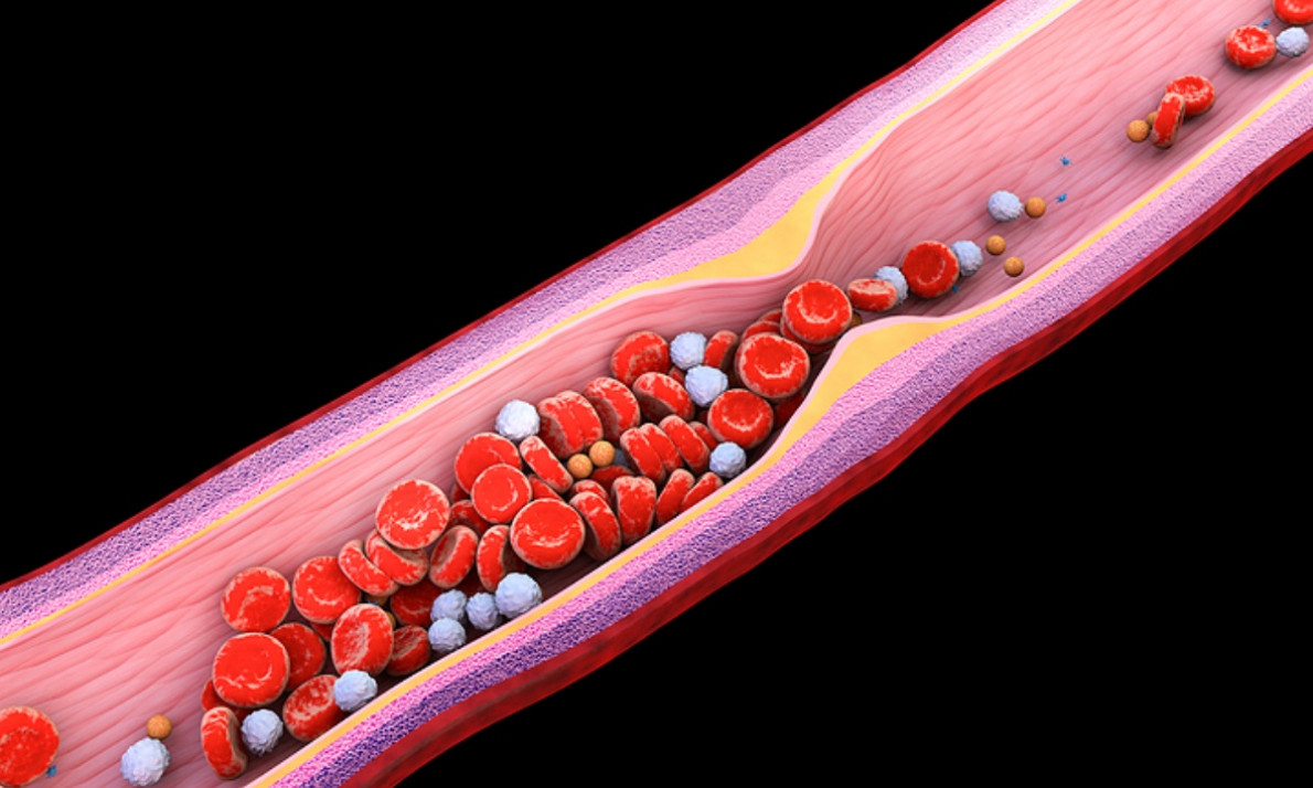 Υψηλή χοληστερίνη: Οι άγνωστες επιπτώσεις πλην του εμφράγματος και του εγκεφαλικού (εικόνες)
