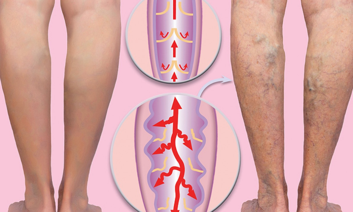 Οι τροφές που προστατεύουν τις φλέβες και τις αρτηρίες (εικόνες)