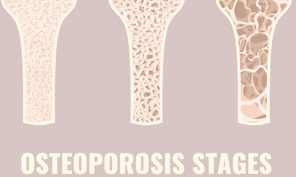 Μέτρηση οστικής πυκνότητας: Ποιοι και πότε πρέπει να κάνουν την εξέταση (εικόνες)