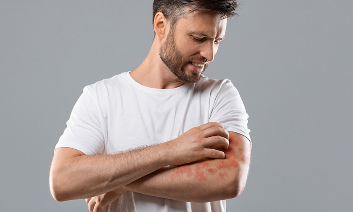 Έκζεμα ενηλίκων: Για ποιες καρδιαγγειακές παθήσεις αυξάνει τον κίνδυνο (εικόνες)