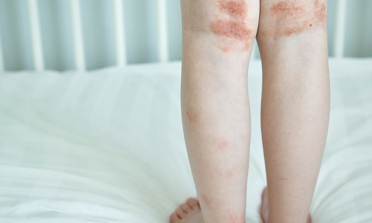 Παγκόσμια Ημέρα Ατοπικής Δερματίτιδας: Η βιταμίνη που ανακουφίζει από τα συμπτώματα (εικόνες)