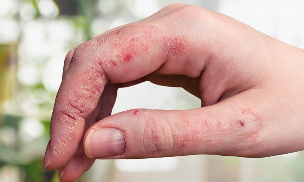 Ψωρίαση: Για ποιες μορφές καρκίνου αυξάνει τον κίνδυνο (εικόνες)