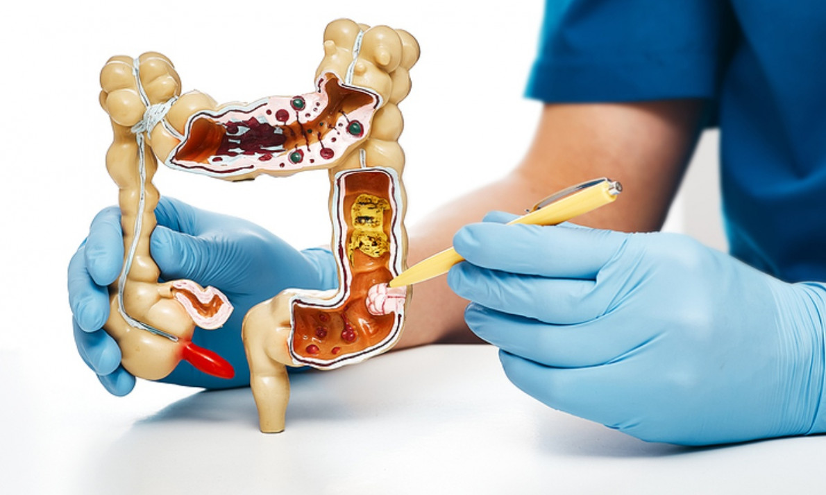 Καρκίνος παχέος εντέρου: Τι μπορείτε να κάνετε για να τον προλάβετε (εικόνες)