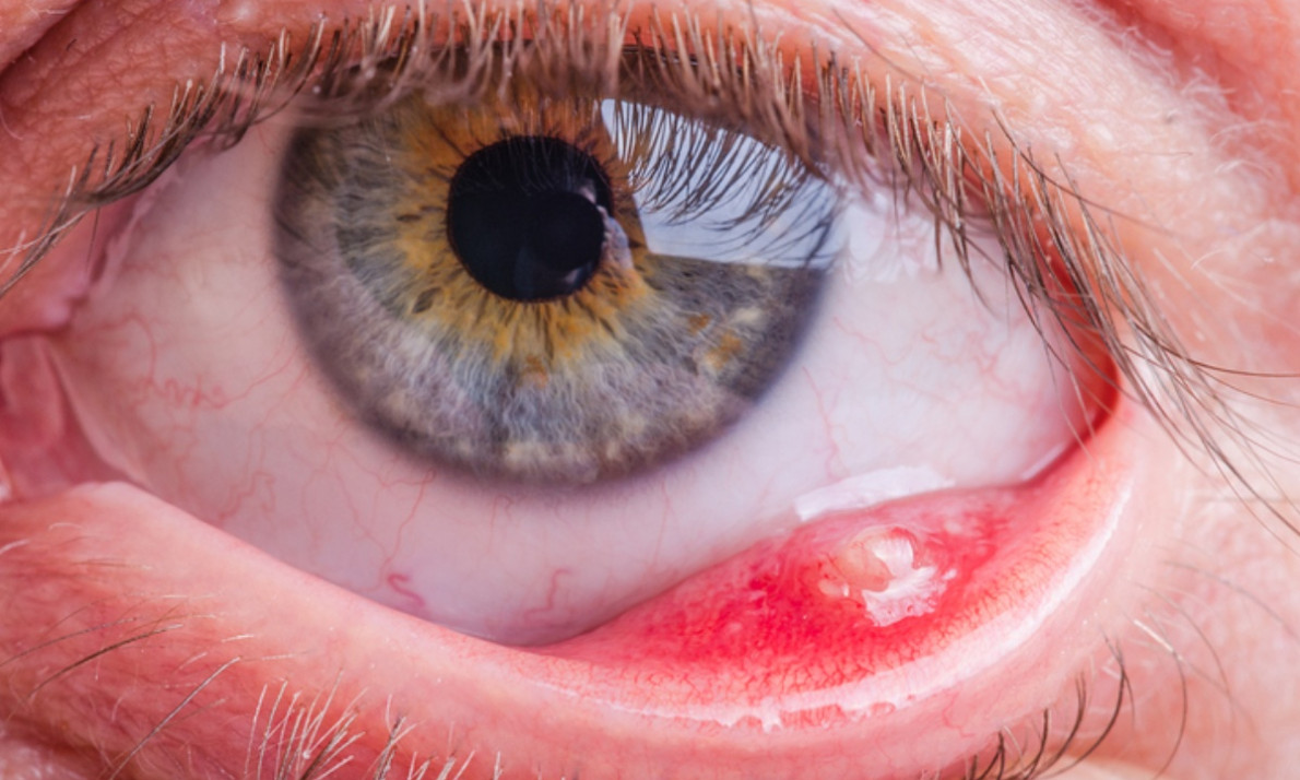 Κριθαράκι στο μάτι: 9 εύκολοι τρόποι για να υποχωρήσει (εικόνες)