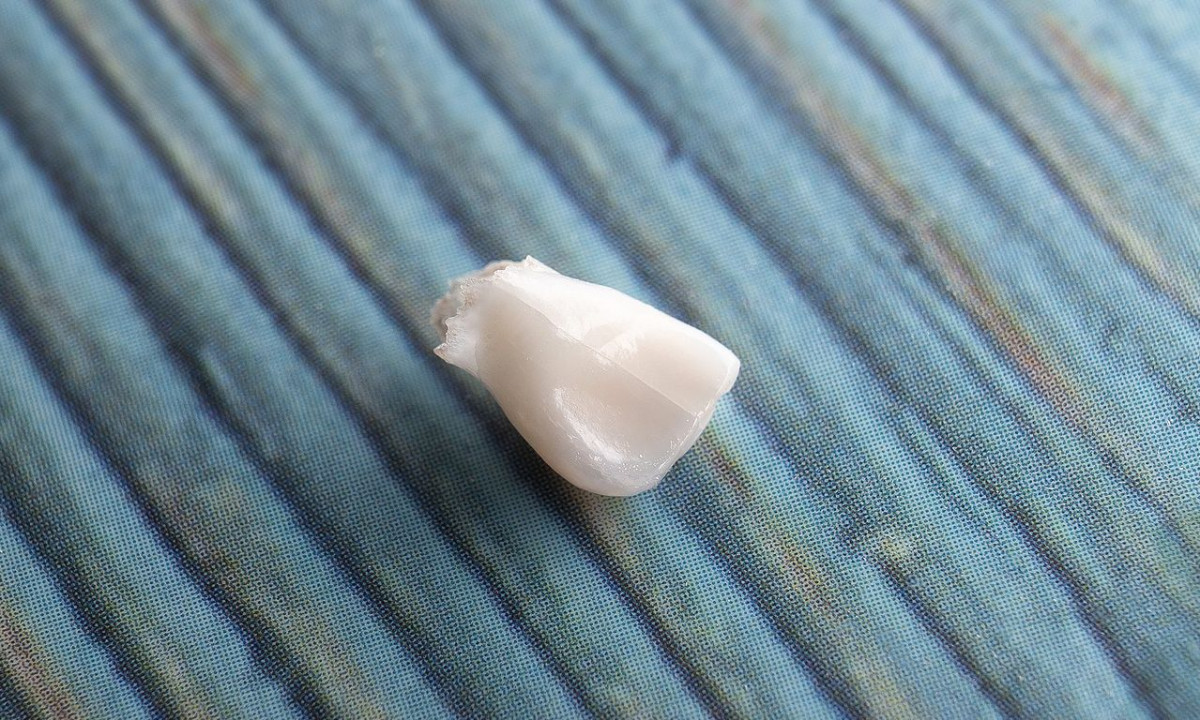 Ονειροκρίτης: Είδες στο όνειρό σου οτι χάνεις δόντια; Δες τι σημαίνει και ποιο μήνυμα κρύβει