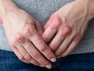 Ψωρίαση: Οι τροφές που αμβλύνουν τα συμπτώματα (εικόνες)