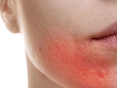 Οι «καλές» συνήθειες που πυροδοτούν την ακμή (εικόνες)