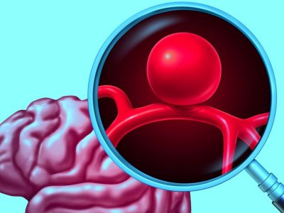 Ανεύρυσμα: Οι κύριες αιτίες ρήξης (εικόνες)