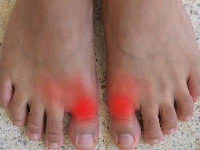 Ουρική αρθρίτιδα: Ποιοι κινδυνεύουν από τη φλεγμονώδη νόσο των αρθρώσεων (εικόνες)