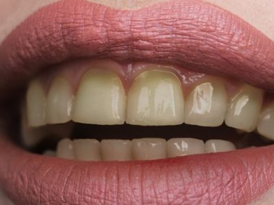 Δόντια που κιτρινίζουν: Οι τροφές που πρέπει να αποφεύγετε (εικόνες)