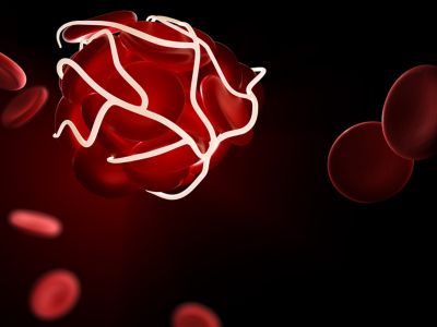 Θρόμβωση: 5 παράγοντες που αυξάνουν σημαντικά τον κίνδυνο (εικόνες)