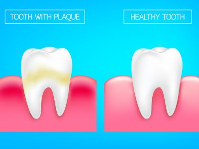 Πλάκα στα δόντια: 10 φυσικοί τρόποι να την απομακρύνετε (βίντεο)