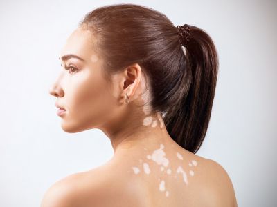 Λεύκη: Γνωρίστε τη δερματική πάθηση μέσα από φωτογραφίες