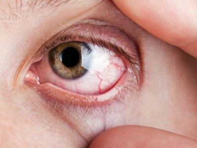 Σύνδρομο Sjögren: 7 συμπτώματα της συχνής αυτοάνοσης πάθησης μέσα από φωτογραφίες