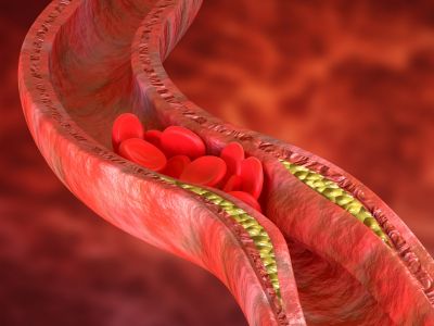 Σημάδια που δείχνουν σοβαρό πρόβλημα στις αρτηρίες (εικόνες)