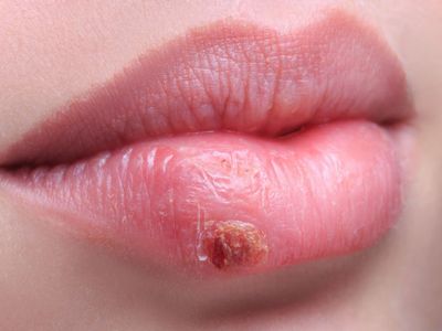 Επιχείλιος έρπης: Πώς θα τον προλάβετε (εικόνες)