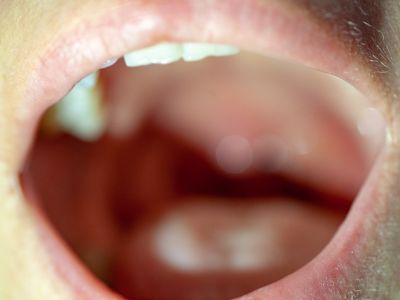 Στοματικά έλκη: Πώς θα τα αντιμετωπίσετε (εικόνες)