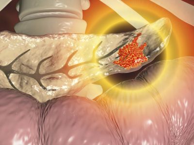 Πάγκρεας: Τα ανησυχητικά σημάδια που πρέπει να γνωρίζετε (εικόνες)