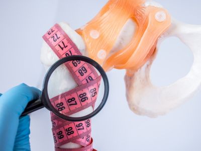 Οστεοπόρωση: Οι παράγοντες που αυξάνουν τον κίνδυνο (εικόνες)