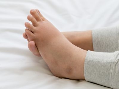 Πρησμένα πόδια λόγω κατακράτησης υγρών: Πώς θα το αντιμετωπίσετε (εικόνες)