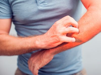 Δερματίτιδα: Αναγνωρίστε τα σημάδια μέσα από εικόνες