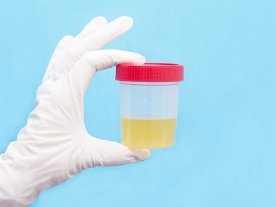 Ούρα: 5 πράγματα που φανερώνουν για την υγεία (εικόνες)