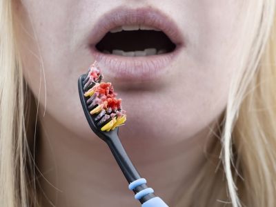 Περιοδοντίτιδα: Για ποιες θανάσιμες παθήσεις αυξάνει τον κίνδυνο (εικόνες)