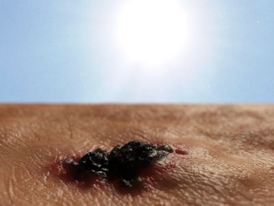 Καρκίνος δέρματος: Τα προειδοποιητικά σημάδια μέσα από φωτογραφίες