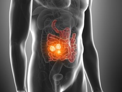 Ορθοκολικός καρκίνος: Οι παράγοντες που αυξάνουν τον κίνδυνο (εικόνες)