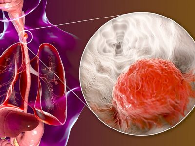 Καρκίνος οισοφάγου: Πώς θα μειώσετε τον κίνδυνο (εικόνες)