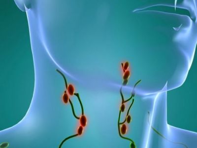 Καρκίνος στους λεμφαδένες: Αυτά είναι τα προειδοποιητικά σημάδια (εικόνες)