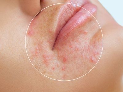 Ακμή: Οι κανόνες διατροφής που πρέπει να τηρείτε ευλαβικά (εικόνες)