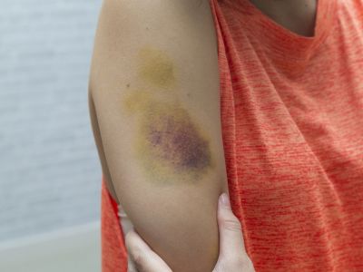 Μελανιάζετε εύκολα; Δείτε τις πιθανές αιτίες (εικόνες)