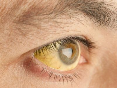 Καρκίνος στο πάγκρεας: 7 άγνωστα συμπτώματα του πιο θανατηφόρου καρκίνου (φωτο)