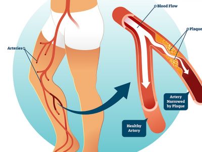 Περιφερική αρτηριοπάθεια: Τι είναι και ποιοι κινδυνεύουν περισσότερο (εικόνες)