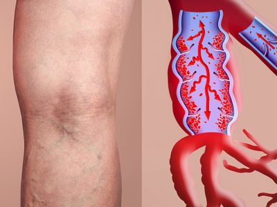 Θρόμβωση: Τα σημάδια-SOS που πρέπει να γνωρίζετε (εικόνες)