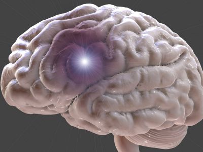 Ανεύρυσμα εγκεφάλου: Με ποια συμπτώματα εκδηλώνεται (εικόνες)