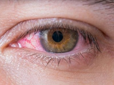 Κοκκίνισμα ματιών: 9 αιτίες & τι μπορείτε να κάνετε (φωτο)